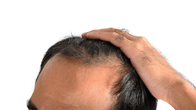 What is Androgenetic Alopecia?